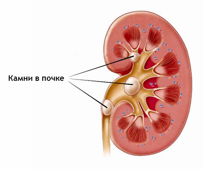 Почечнокаменная болезнь: симптомы, лечение