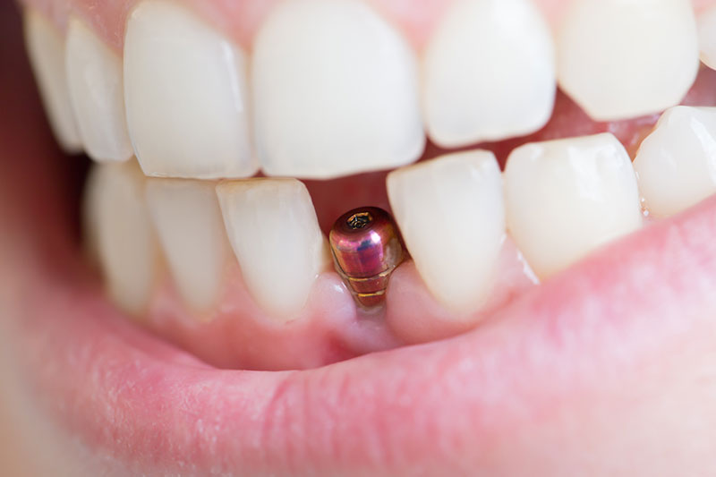 Мифы о зубной имплантации - фотография